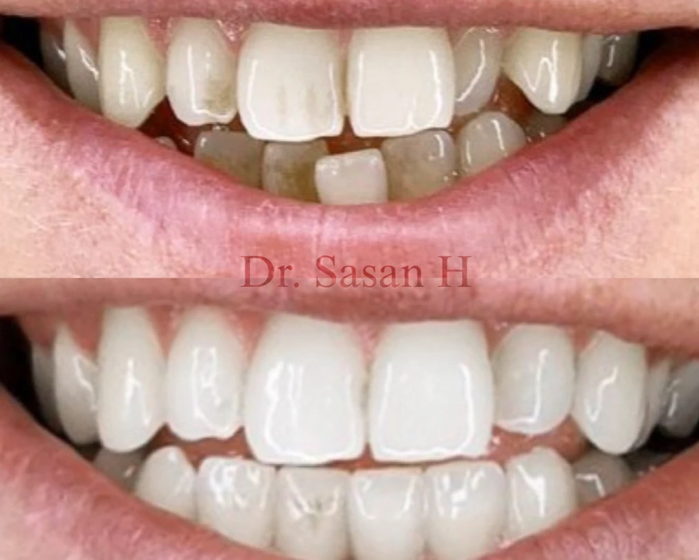 vdsc-smile-make-over_before-after-1 2