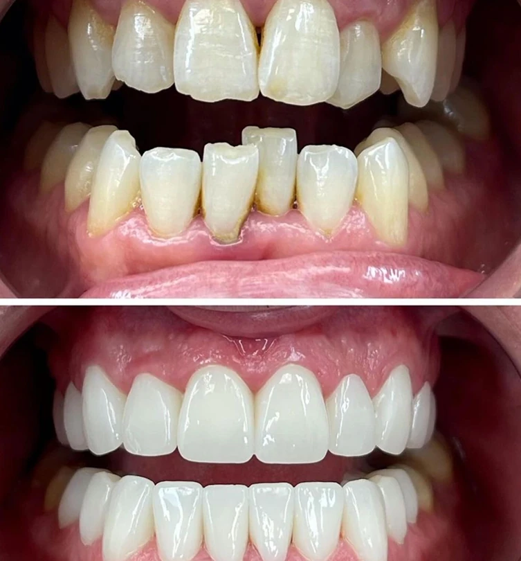 vdsc-smile-make-over_before-after-1 3