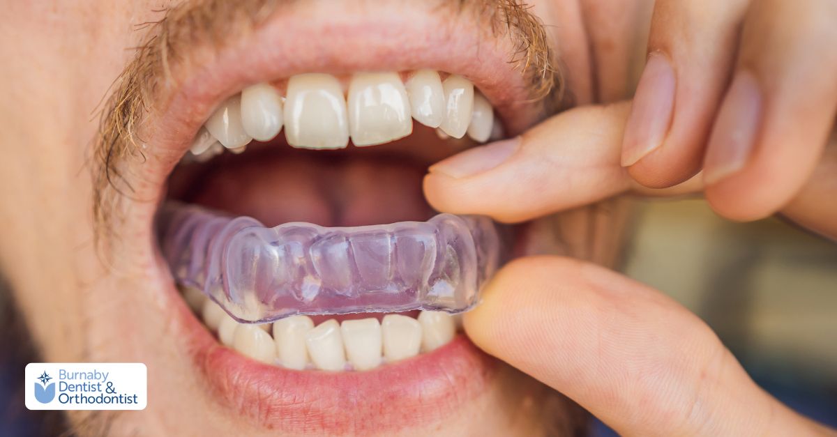 Nightguard vs. Sports Mouthguard in Burnaby: Custom Fit with Digital Scans Person placing a clear dental nightguard over their teeth.