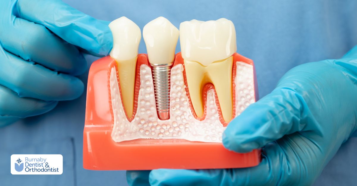 Dental implant model showing how an implant replaces a missing tooth.