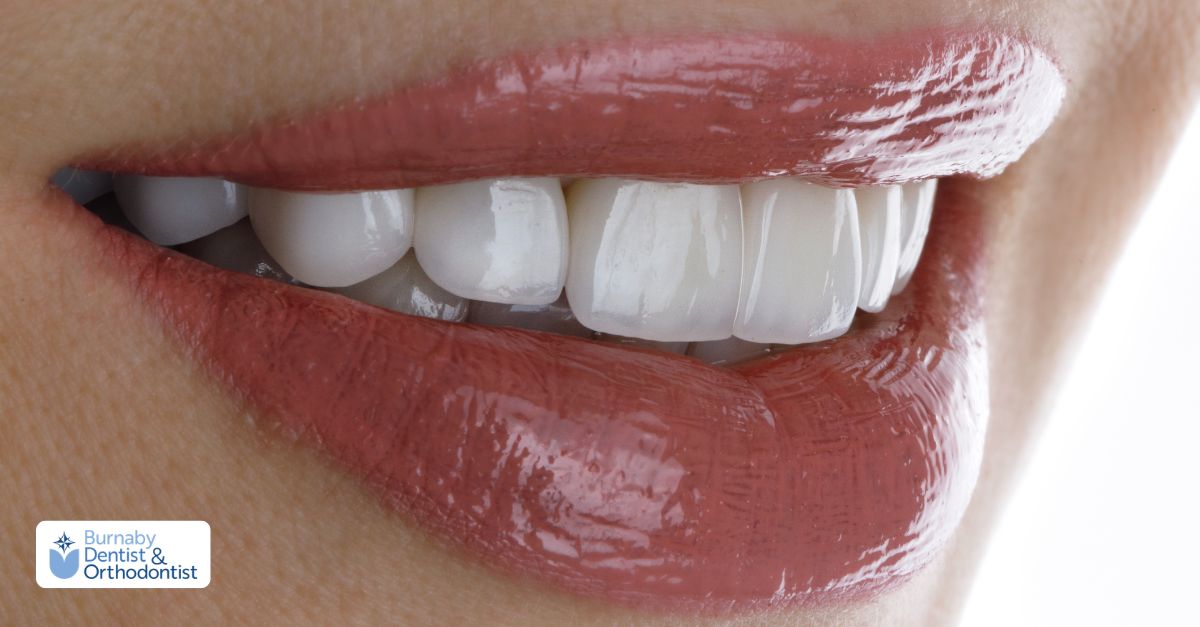 Close-up image illustrating dental veneers for smile enhancement.