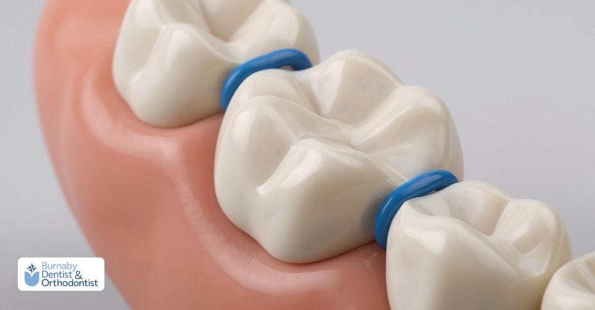 A tooth featuring blue orthodontic separators, highlighting dental treatment for alignment.