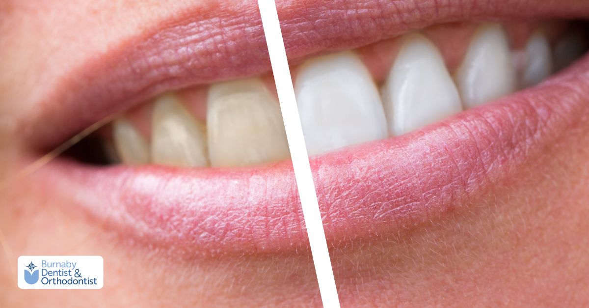 Before and after images of a woman with a radiant smile, emphasizing the effects of cosmetic dentistry on her teeth.