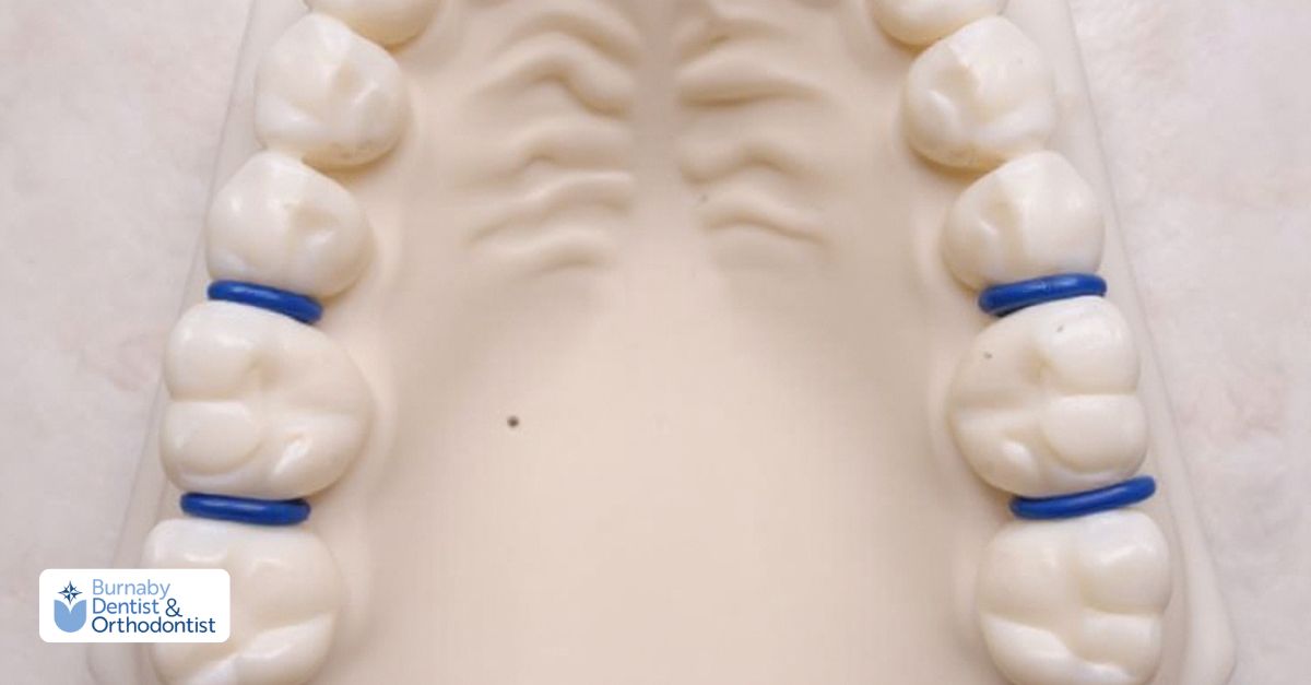orthodontic spacers in anathomy of the teeth