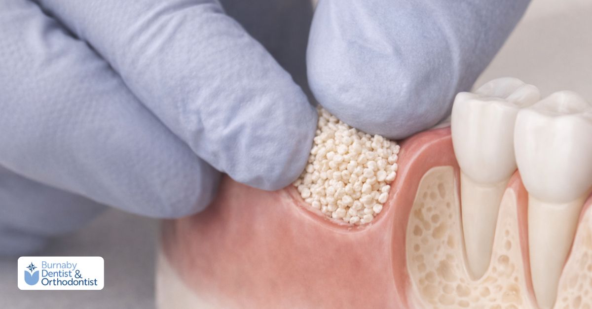 Dental bone grafting procedure showing how graft material is placed to rebuild lost jawbone