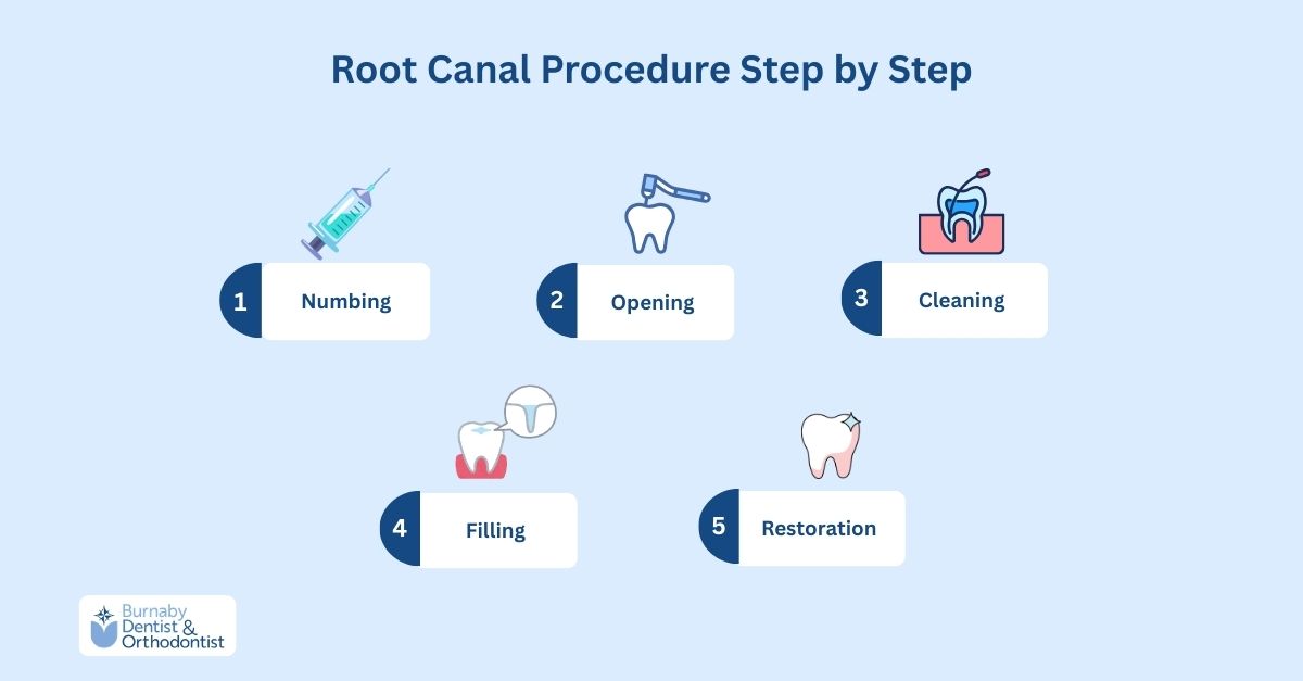 Infographic showing five stages of a root canal treatment