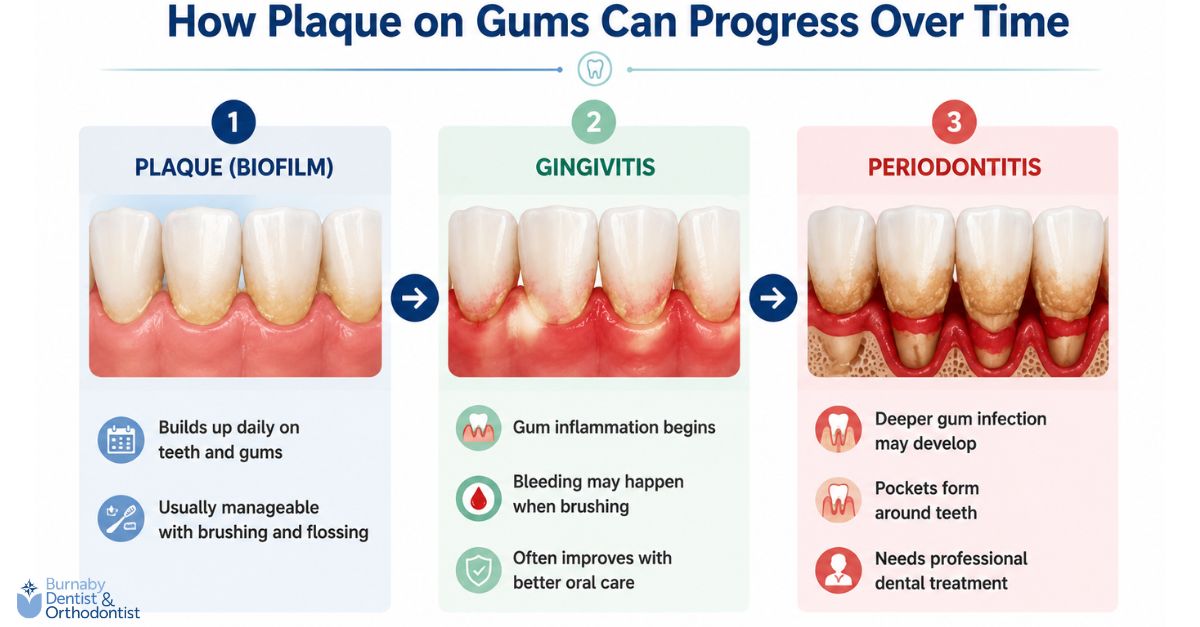 An infographic showing the progression of plaque buildup from biofilm to gingivitis and periodontitis, including gum inflammation, bleeding, and deeper gum infection over time