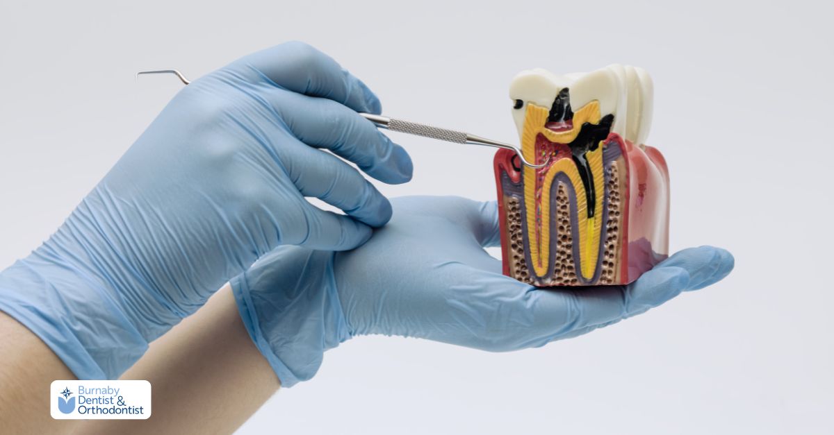 Close-up of tooth model explaining root canal procedure.