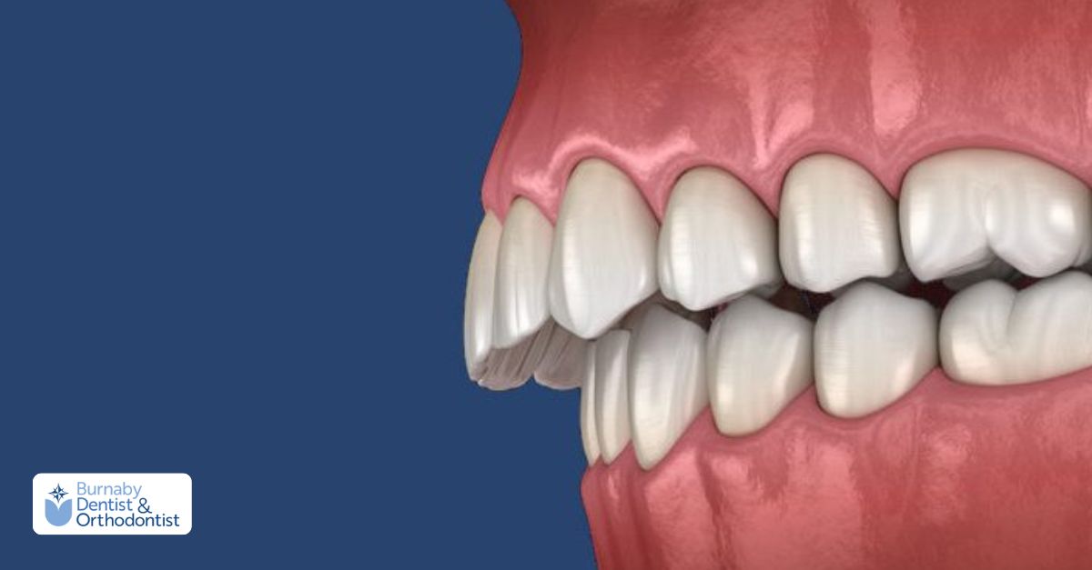 Side view of an overbite demonstrating excessive upper tooth overlap and bite misalignment.