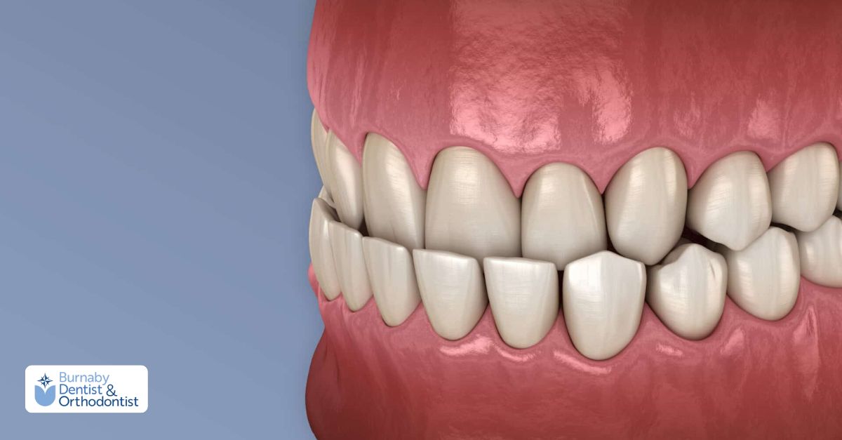 Side view of an underbite demonstrating jaw misalignment and improper bite alignment.
