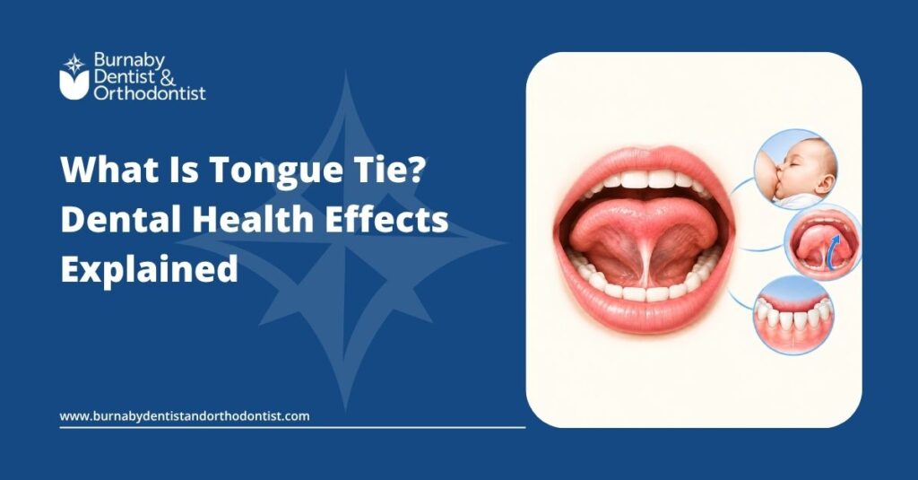 Illustration of a tongue tie showing a restrictive lingual frenulum beneath the tongue and its potential relevance to oral function and dental health.