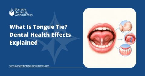 Illustration of a tongue tie showing a restrictive lingual frenulum beneath the tongue and its potential relevance to oral function and dental health.