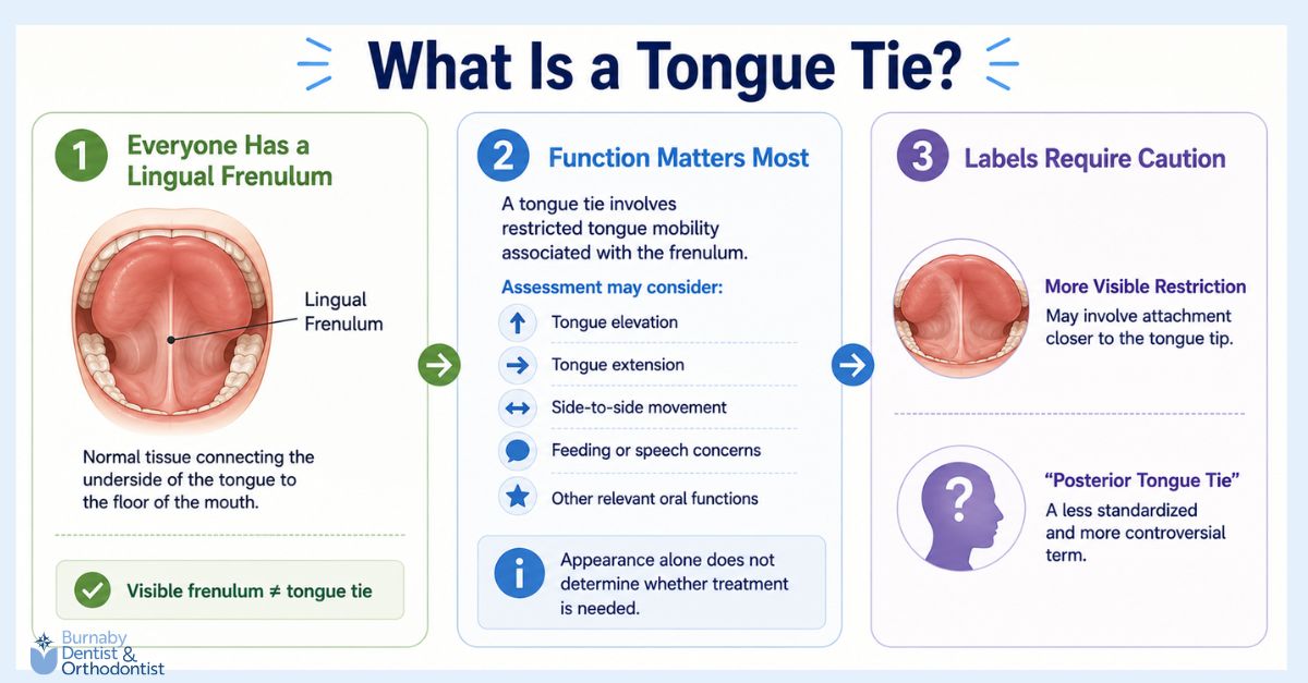  Infographic explaining tongue tie, showing the lingual frenulum, tongue mobility and functional assessment factors, and why appearance alone or labels such as posterior tongue tie are not enough to determine diagnosis or treatment.