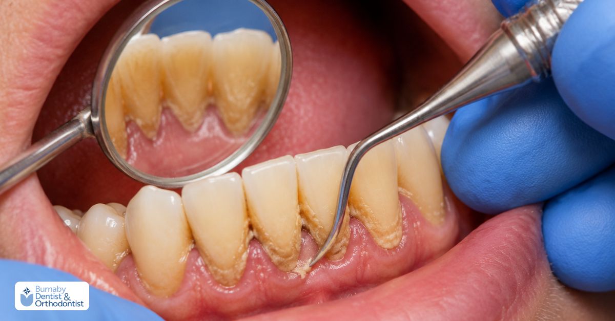 A dentist or dental hygienist using scaling instruments to remove hardened tartar (calculus) from teeth