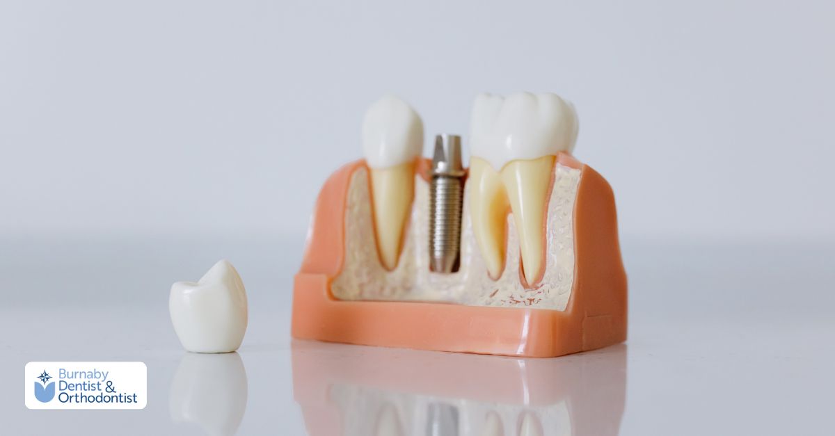 Close-up dental model comparing a dental implant to a traditional tooth replacement option.