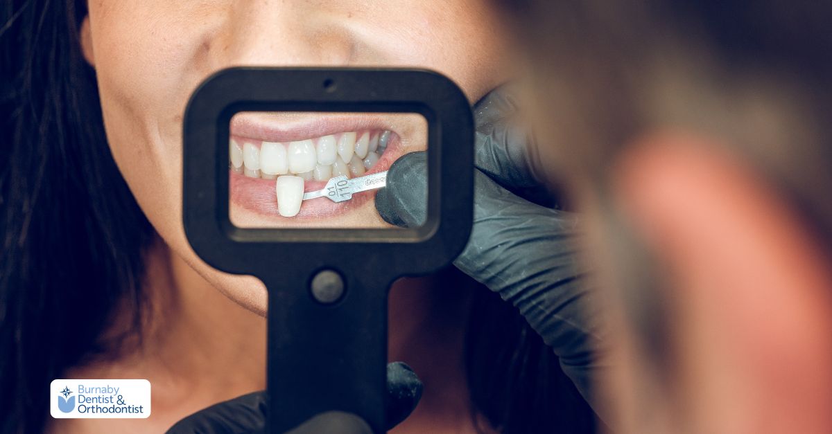 Choosing between veneer options with professional shade comparison