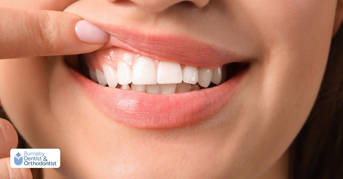 Close-up of healthy gums and teeth after gum graft surgery, showing why diet is important for healing.